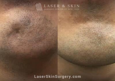 Botox treatments to smooth chin dimple