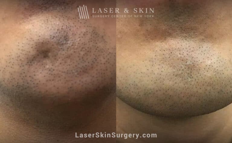 Botox treatments to smooth chin dimple