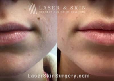Dermal Filler Injections to Improve the Appearance of the Lips
