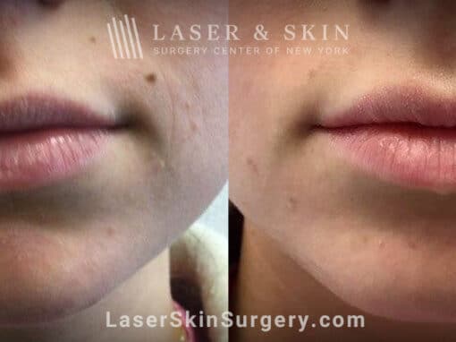 Dermal Filler Injections to Improve the Appearance of the Lips