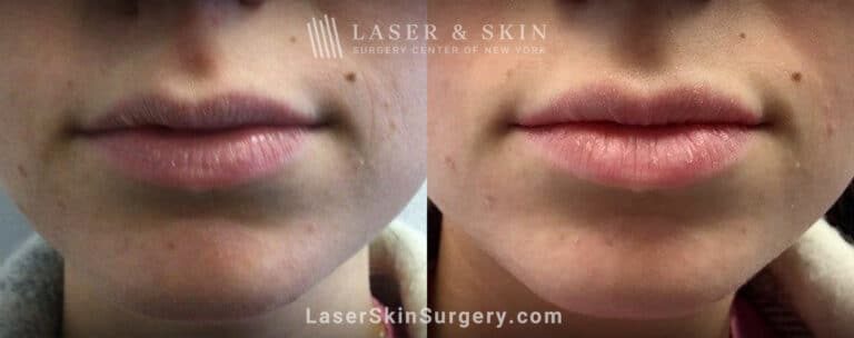 Dermal Filler Injections to Improve the Appearance of the Lips