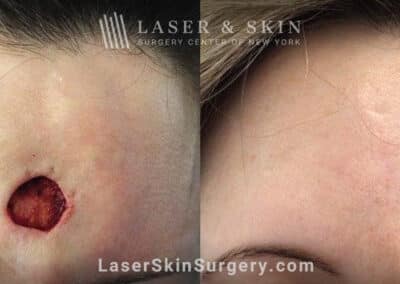 Mohs Surgery to Treat Skin Cancer on the Forehead