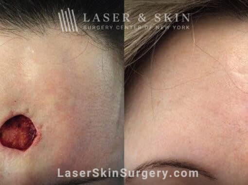 Mohs Surgery to Treat Skin Cancer on the Forehead