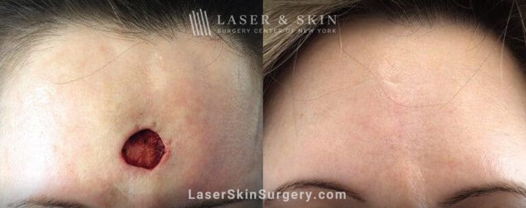 Mohs Surgery to Treat Skin Cancer on the Forehead