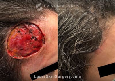 Mohs surgery to remove skin cancer from the head