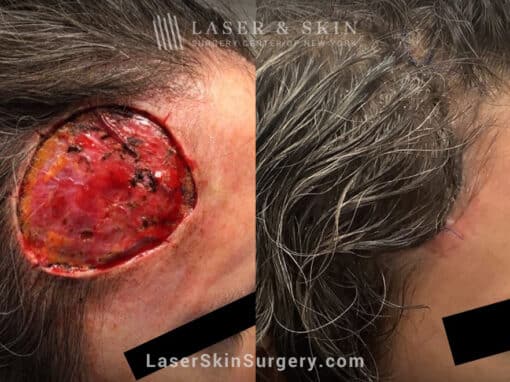 Mohs surgery to remove skin cancer from the head