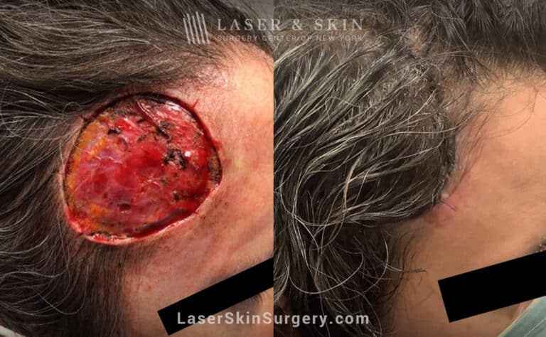 Mohs surgery to remove skin cancer from the head