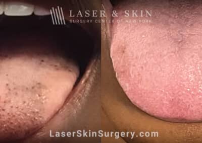 Ruby Laser Treatments to Remove Pigmented Fungiform and Filliform Papilla from the Tongue