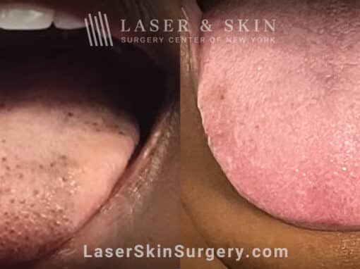 Ruby Laser Treatments to Remove Pigmented Fungiform and Filliform Papilla from the Tongue