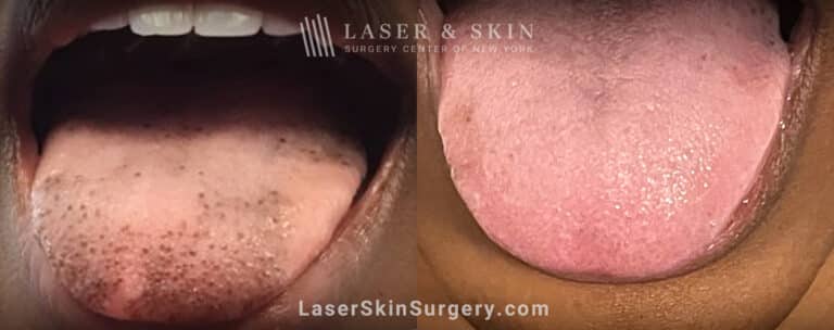 Ruby Laser Treatments to Remove Pigmented Fungiform and Filliform Papilla from the Tongue