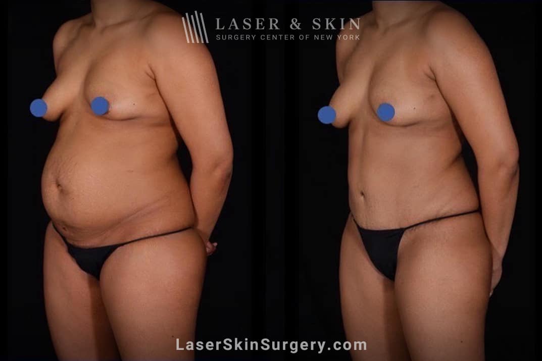 lsscny-nyc-dr-wilson-abdominoplasty-liposuction-1 A mommy makeover is a combination of surgical and nonsurgical treatments designed to restore a woman's body to a pre-pregnancy state.