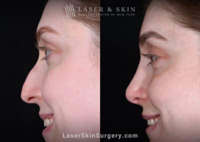 Rhinoplasty and Deviated Septum Repair