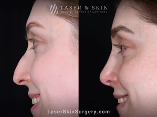 Rhinoplasty and Deviated Septum Repair