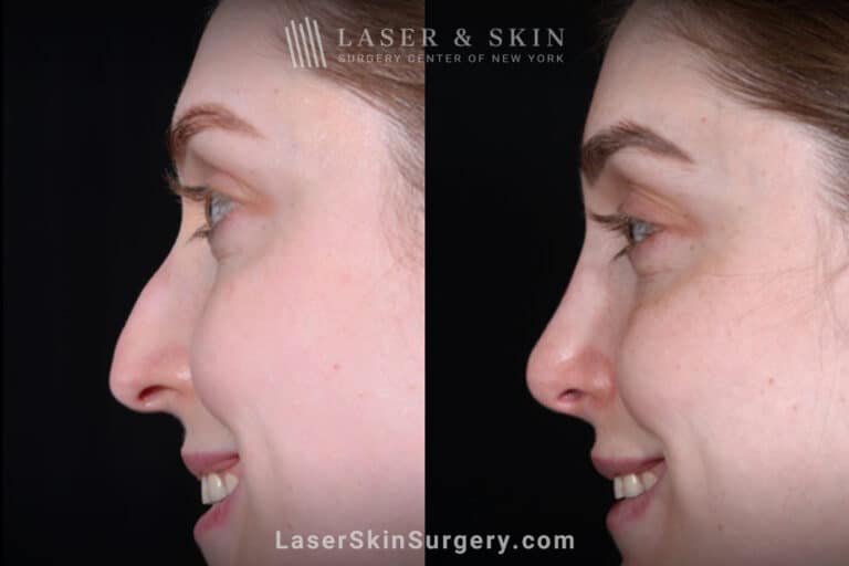 Rhinoplasty and Deviated Septum Repair