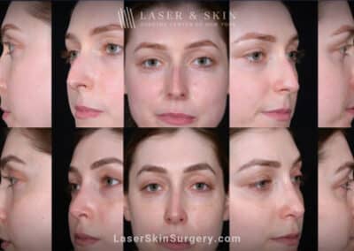 Rhinoplasty and Deviated Septum Repair