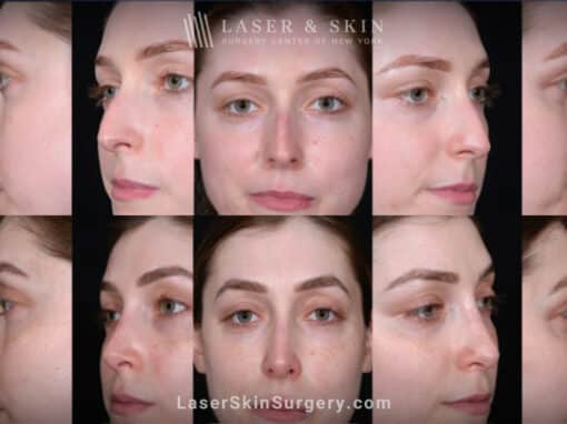 Rhinoplasty and Deviated Septum Repair