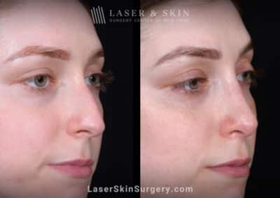Rhinoplasty and Deviated Septum Repair