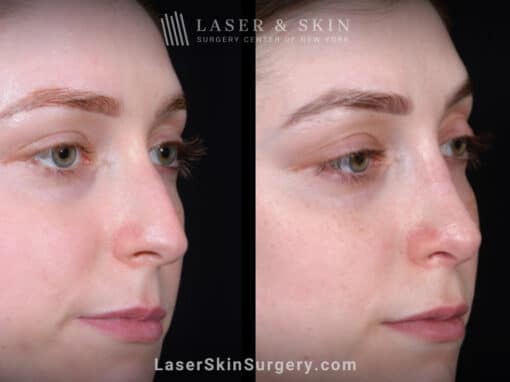 Rhinoplasty and Deviated Septum Repair