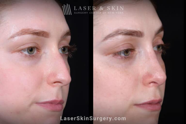 Rhinoplasty and Deviated Septum Repair