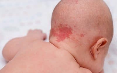 How to Choose a Dermatologist for Your Child With Port Wine Birthmarks
