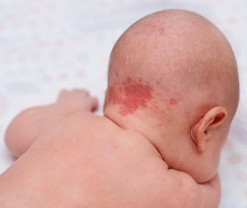 How to Choose a Dermatologist for Your Child With Port Wine Birthmarks