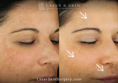 Laser treatments for melasma on the face