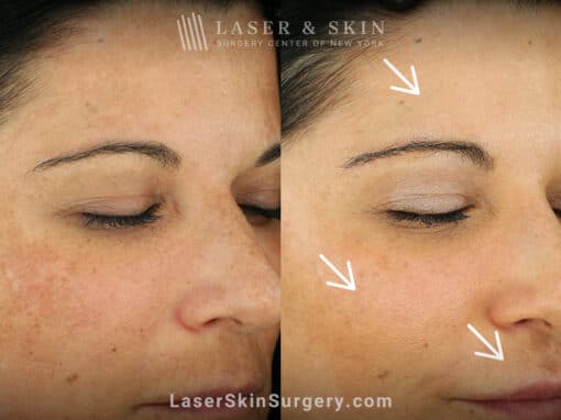 Laser treatments for melasma on the face