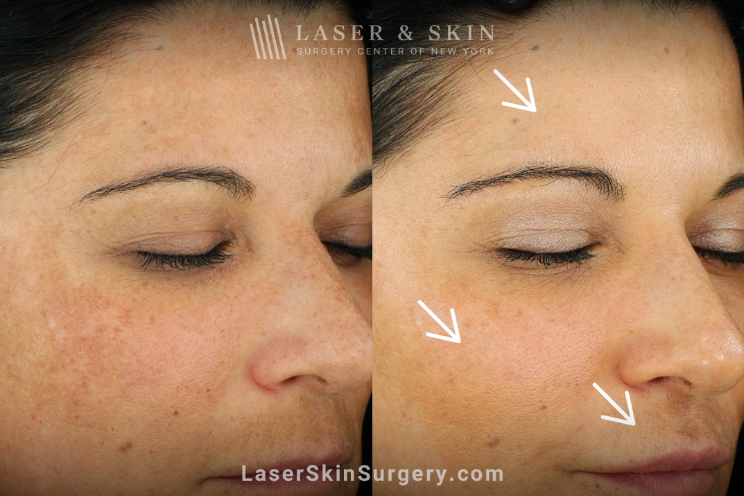 lssc-nyc-devon-before-after-laser-melasma-treatment. facial laser treatments results