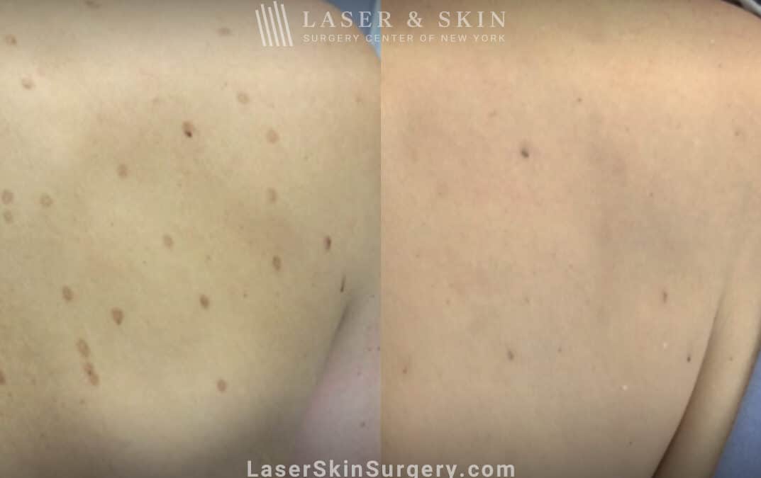 Laser treatments for post-inflammatory hyperpigmentation