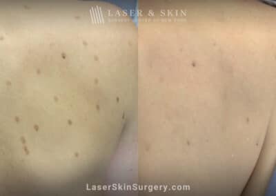 Laser treatments for post-inflammatory hyperpigmentation