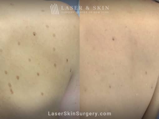 Laser treatments for post-inflammatory hyperpigmentation