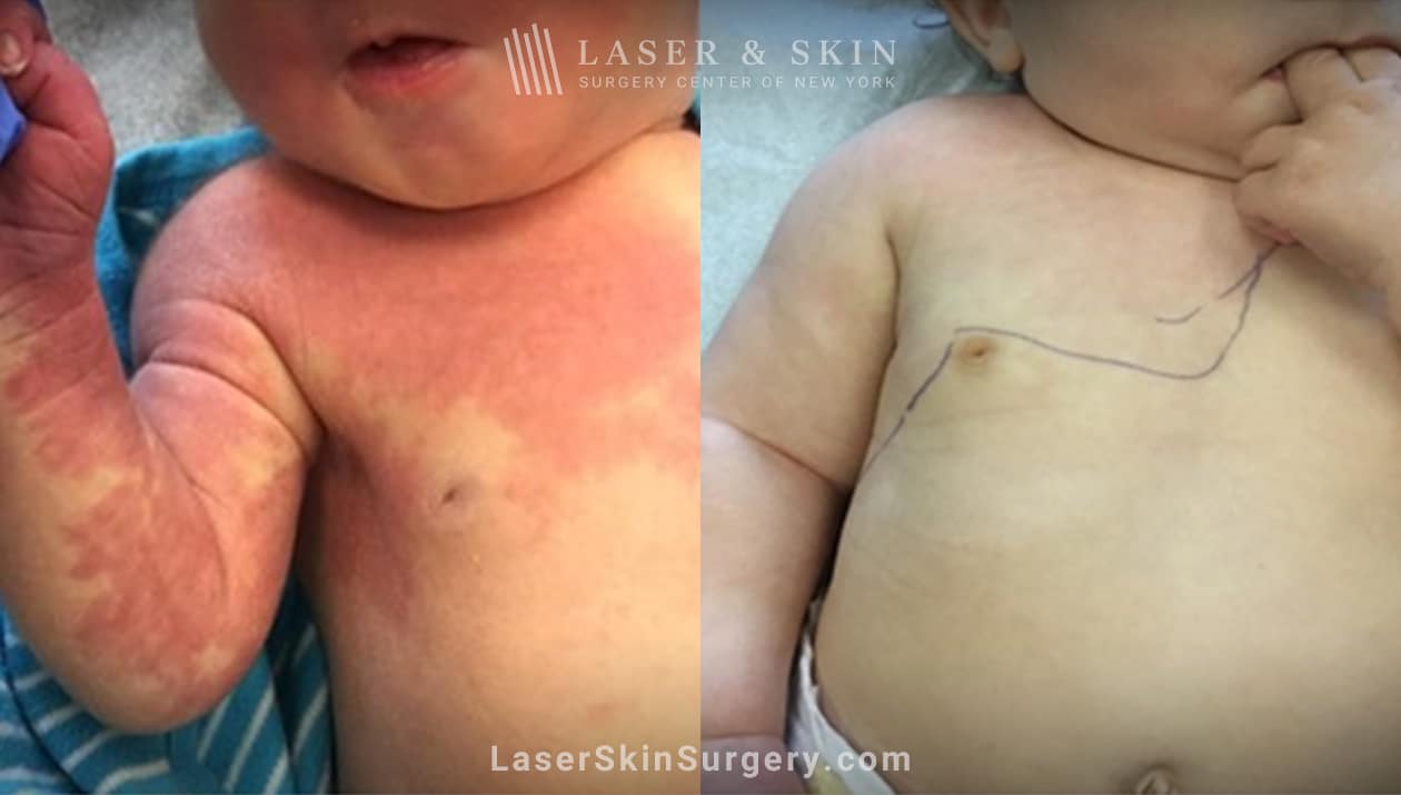 Laser & Skin Surgery Center of New York port wine stain infant before and after New York NY Laser & Skin Surgery Center of New York port wine stain infant before and after New York NY