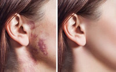 Port Wine Birthmark Laser Treatments: What Patients Need to Know