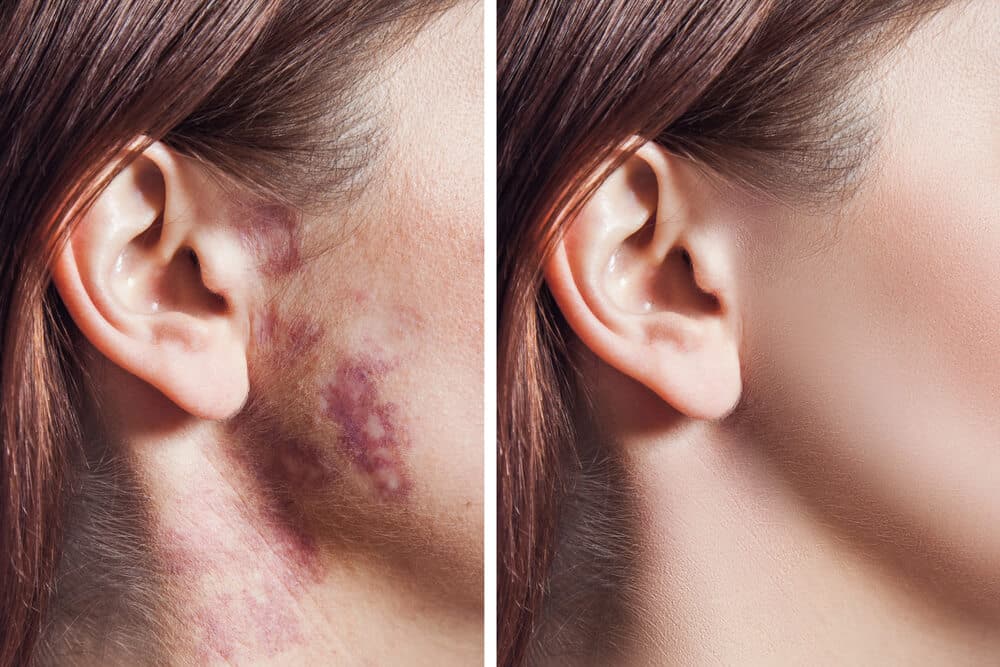 Port Wine Birthmark Laser Treatments: What Patients Need to Know