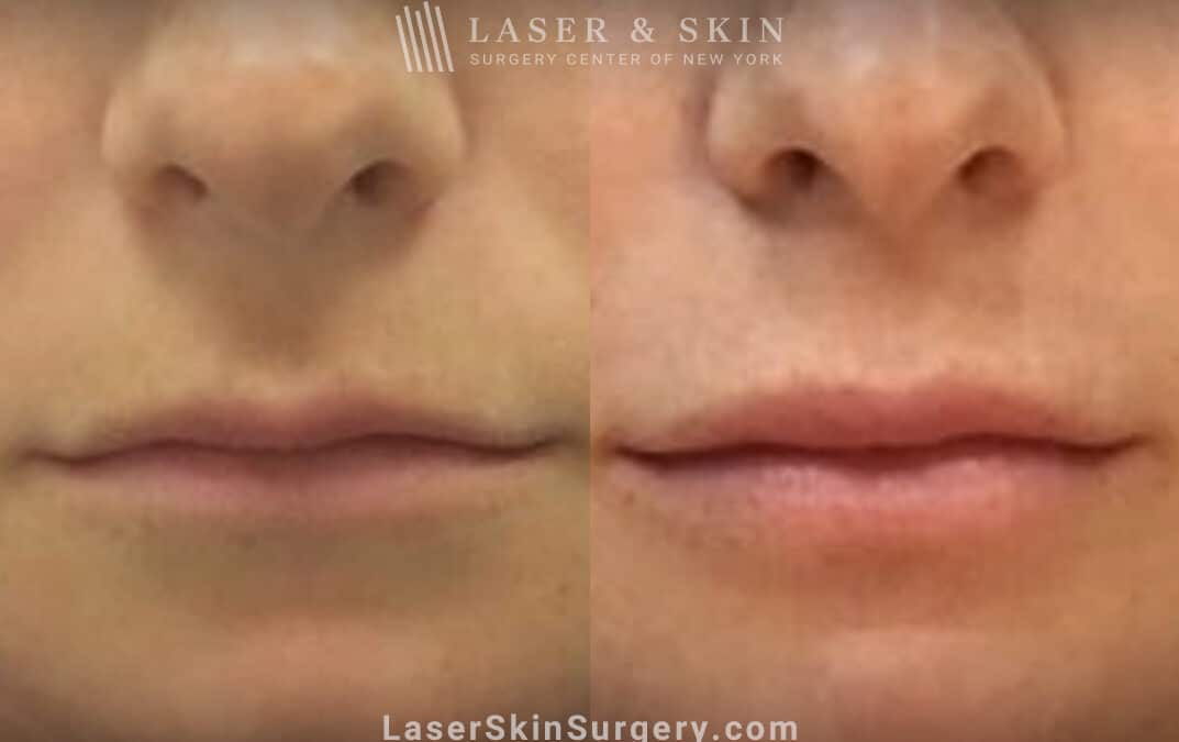 fractional laser resurfacing for wrinkles above lips before and after