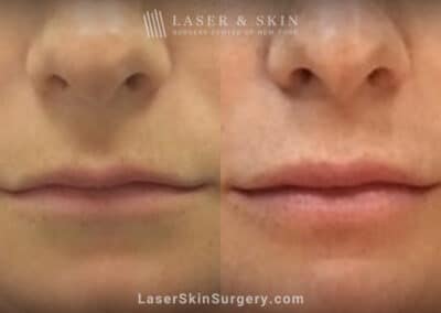 Juvederm Ultra XC to Plump the Lips