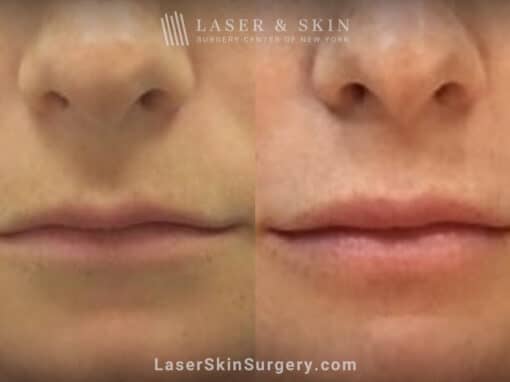 Juvederm Ultra XC to Plump the Lips