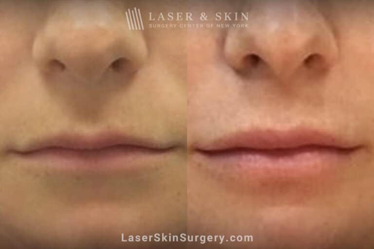 Juvederm Ultra XC to Plump the Lips