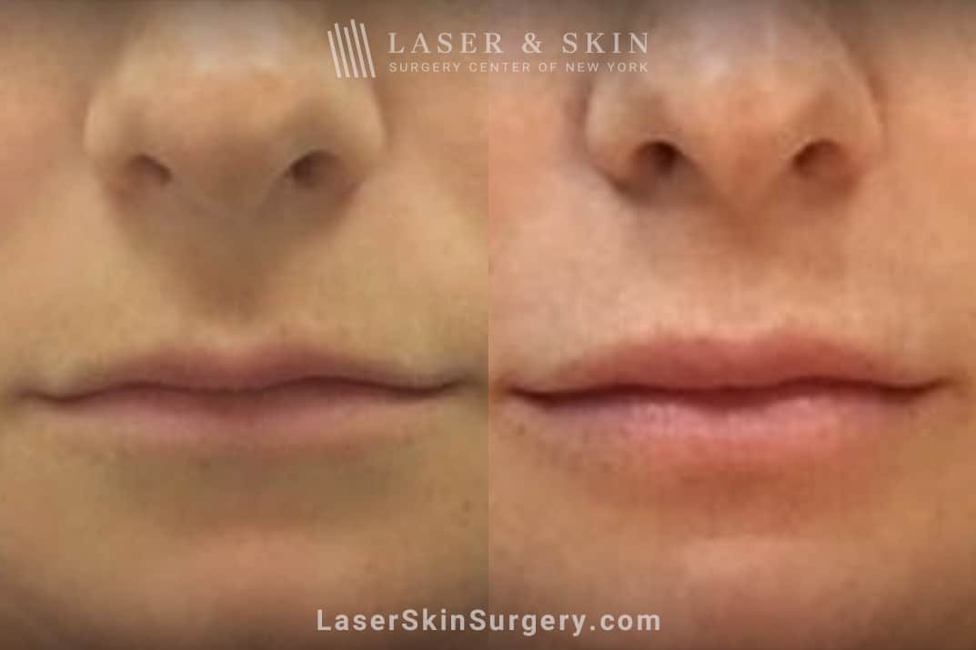 lsscny-nyc-Anolik-Lips-Syringe-Juvederm-Ultra-XC restoring volume in thinning lips before and after