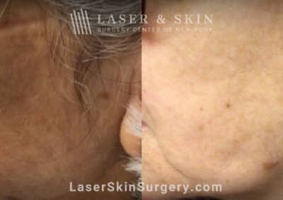 Ruby Laser Treatments for Lentigo (Brown Spot) on the Face