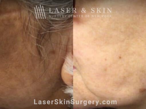 Ruby Laser Treatments for Lentigo (Brown Spot) on the Face