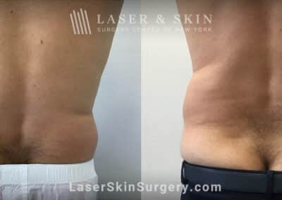 CoolSculpting to Remove Unwanted Fat on the Back