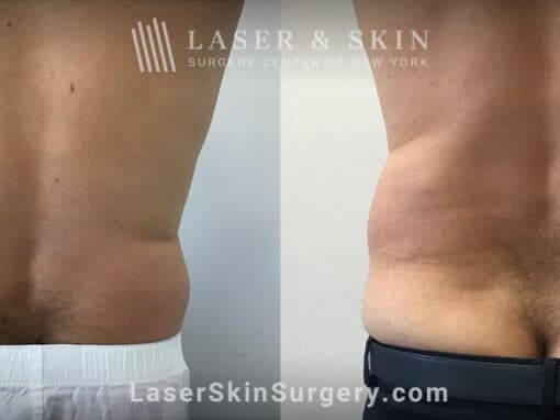 CoolSculpting to Remove Unwanted Fat on the Back