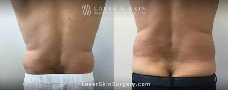 CoolSculpting to Remove Unwanted Fat on the Back