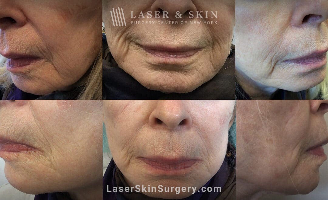 Genius microneedling to tighten the skin around the face