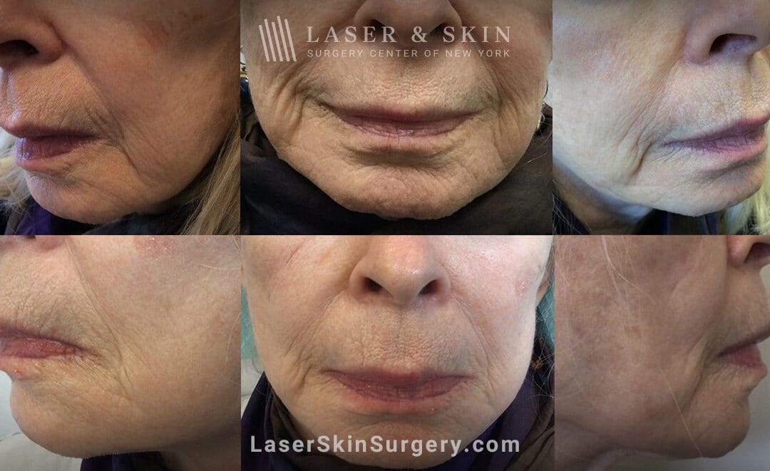 rf microneedling results in new york