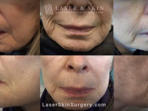 Genius microneedling to tighten the skin around the face