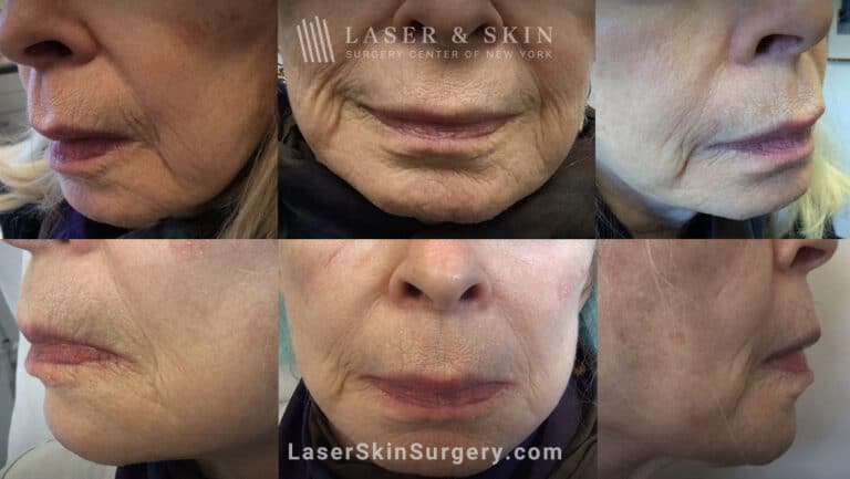 Genius microneedling to tighten the skin around the face