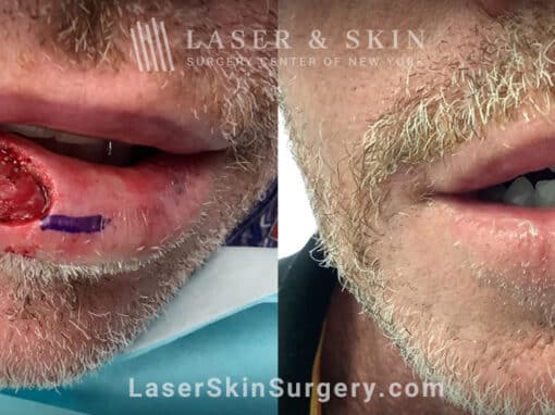 Mohs surgery to treat skin cancer on the lip