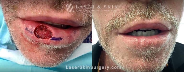 Mohs surgery to treat skin cancer on the lip